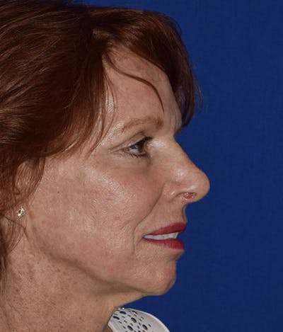 Nose Before & After Gallery - Patient 189961659 - Image 2