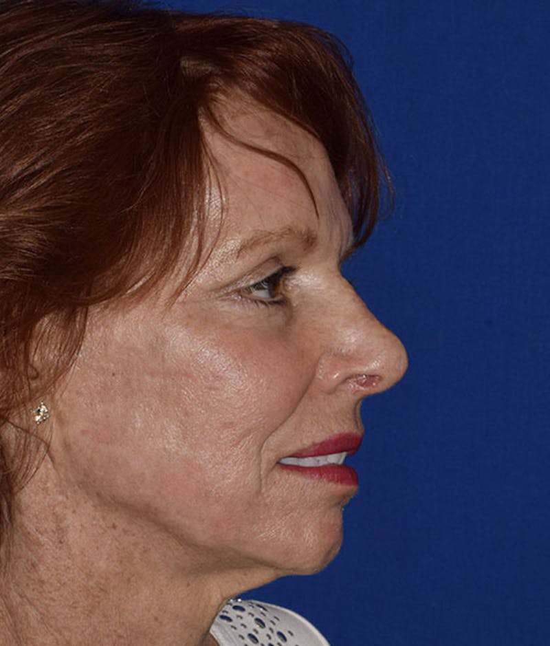 Nose Before & After Gallery - Patient 189961659 - Image 2