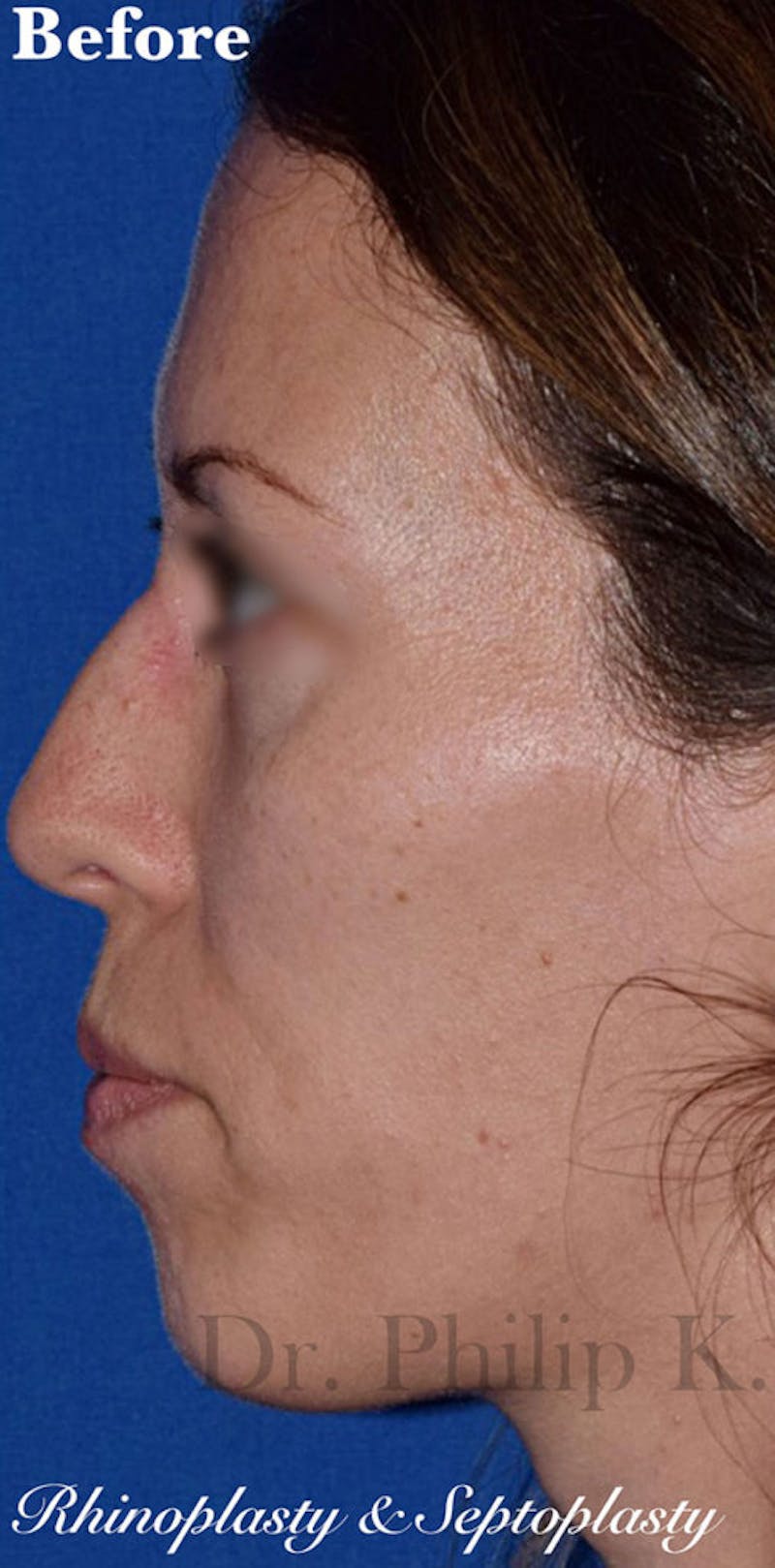 Nose Before & After Gallery - Patient 189961660 - Image 1