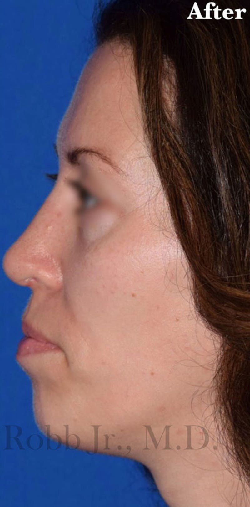 Nose Before & After Gallery - Patient 189961660 - Image 2