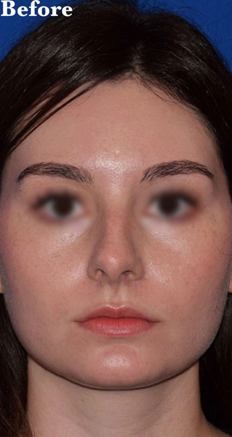 Nose Before & After Gallery - Patient 189961669 - Image 3