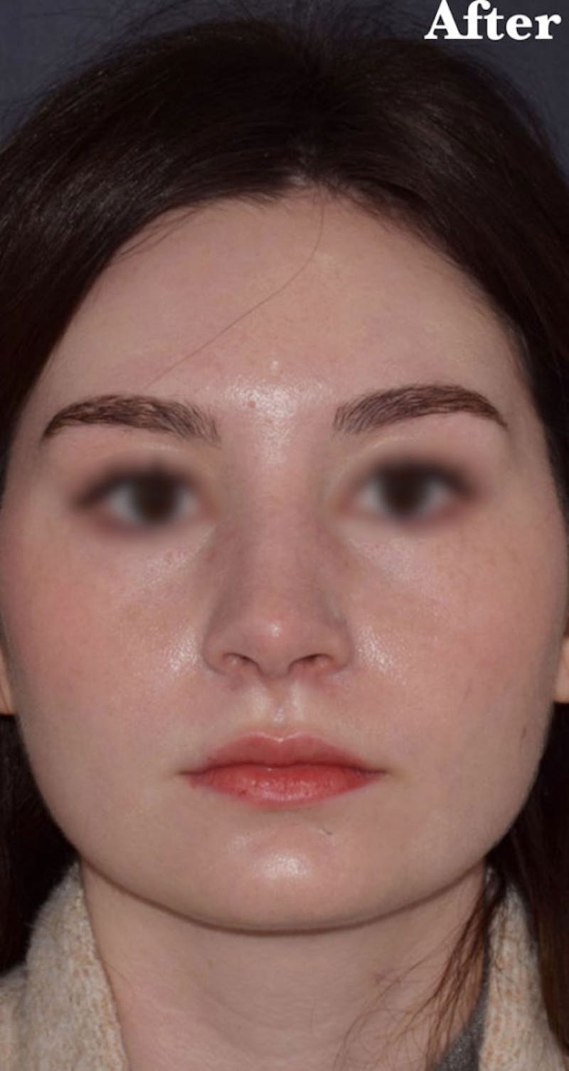 Nose Before & After Gallery - Patient 189961669 - Image 4