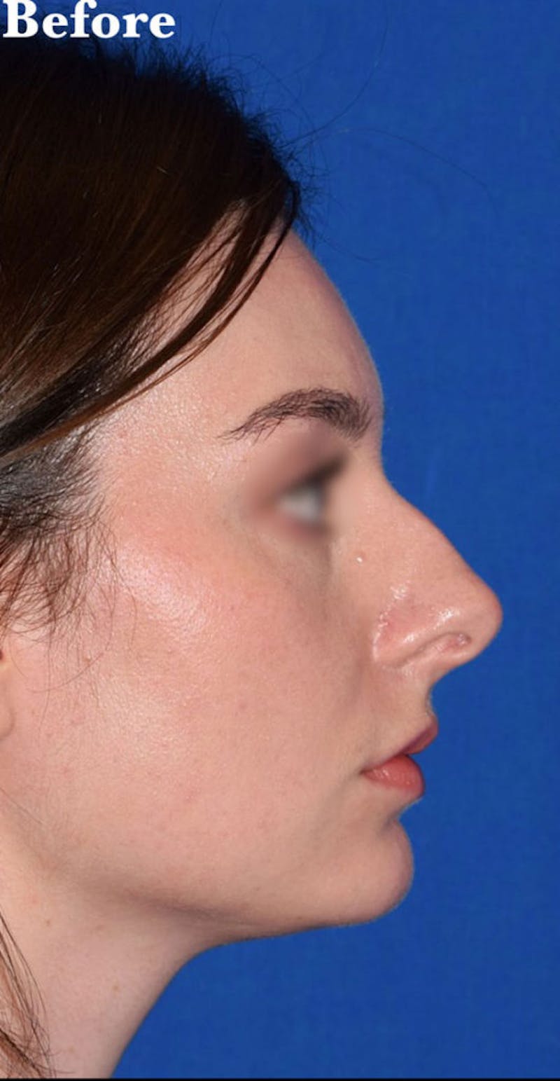 Nose Before & After Gallery - Patient 189961669 - Image 1