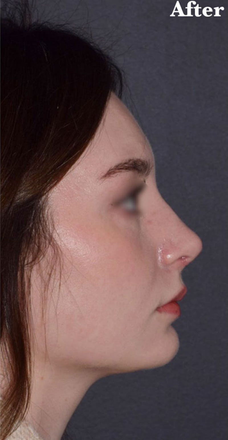 Nose Before & After Gallery - Patient 189961669 - Image 2