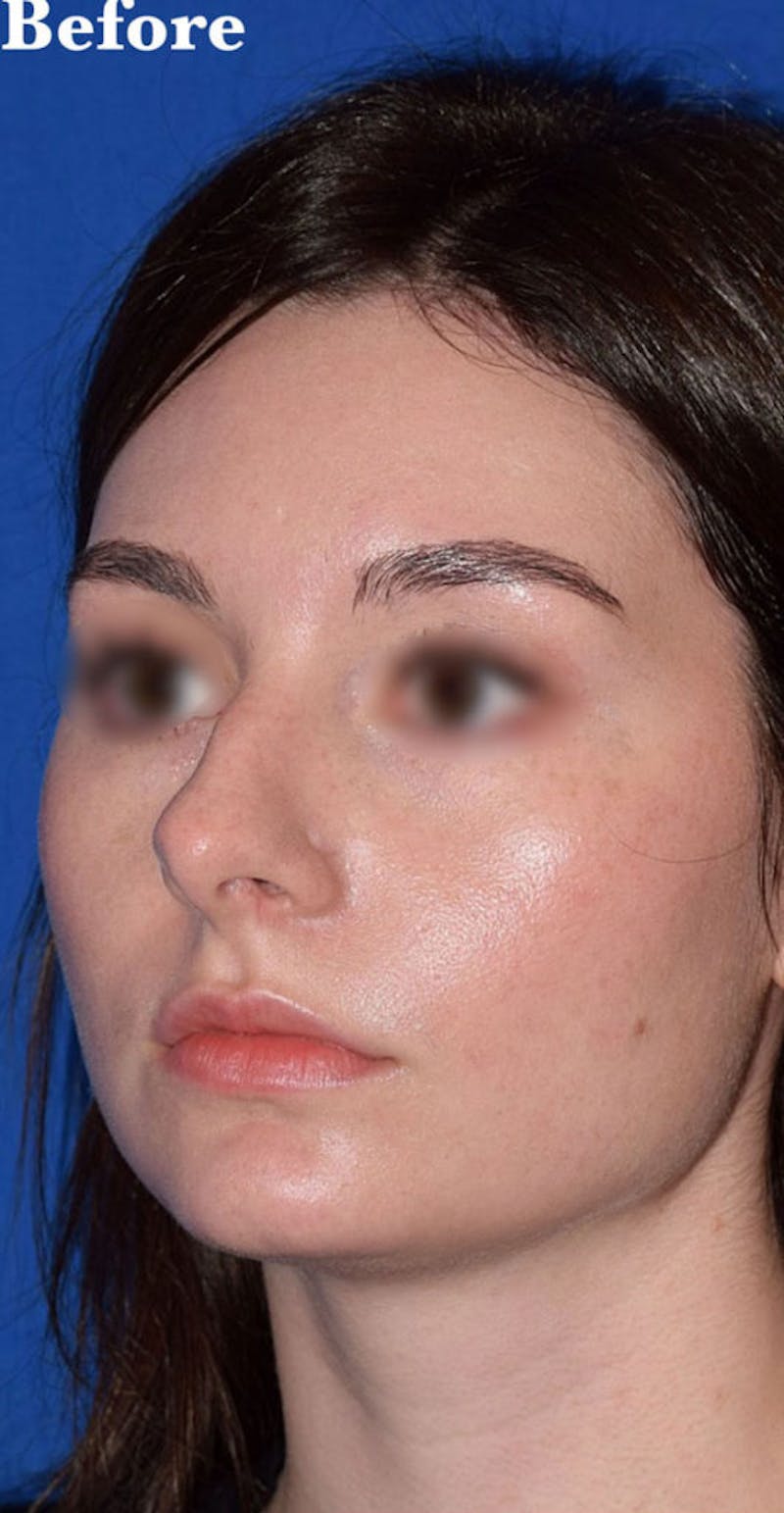 Nose Before & After Gallery - Patient 189961669 - Image 5