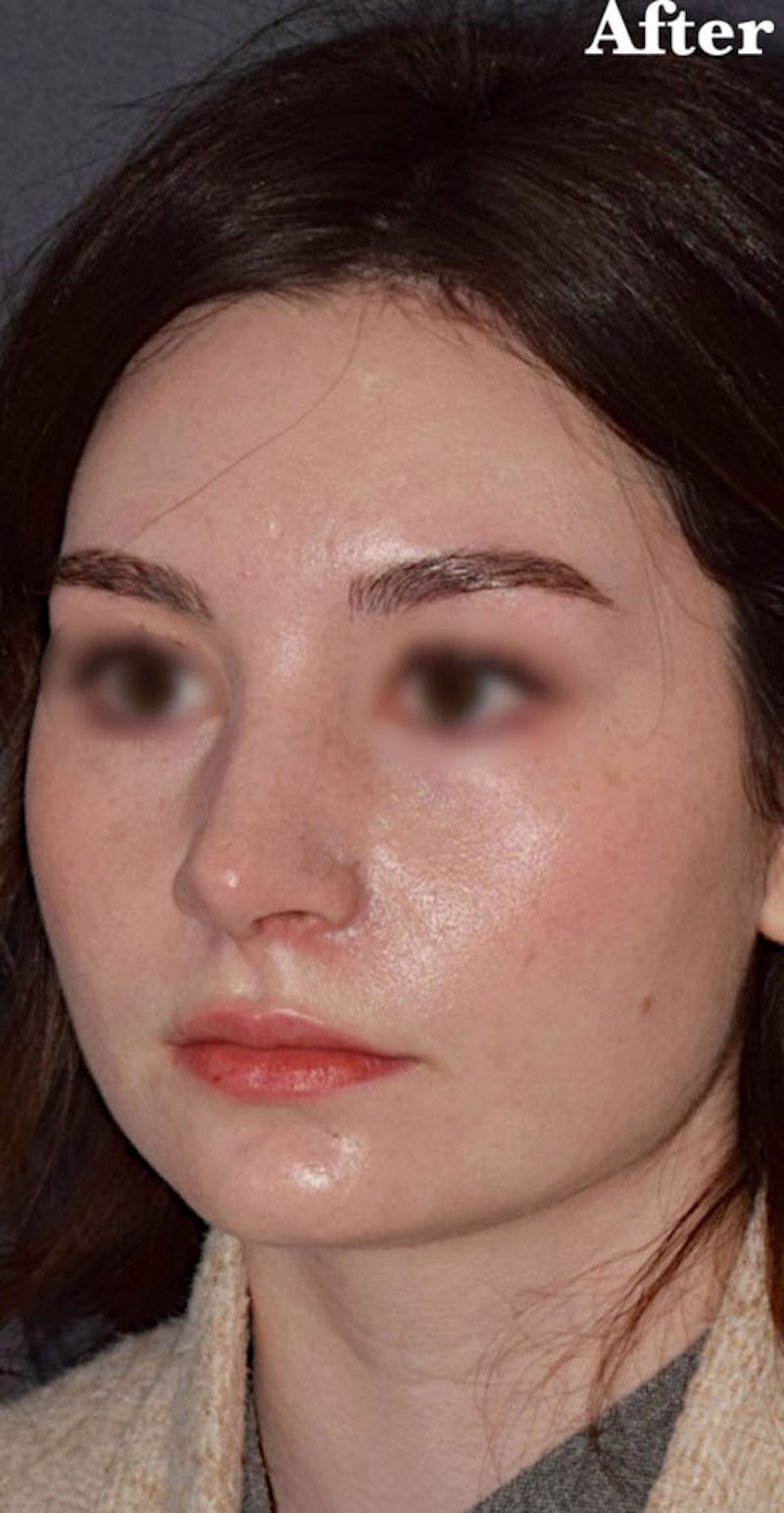 Nose Before & After Gallery - Patient 189961669 - Image 6