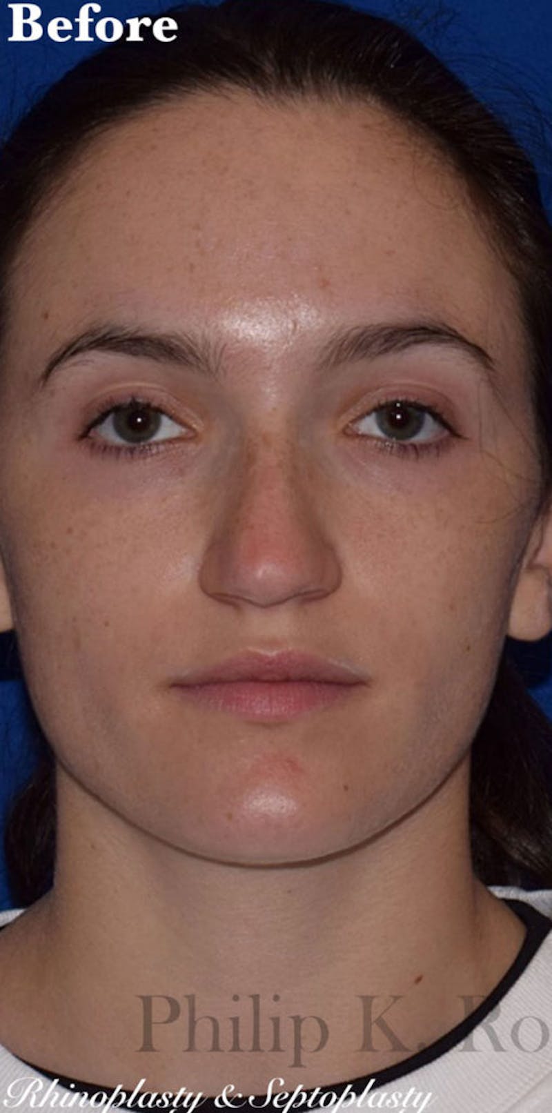 Nose Before & After Gallery - Patient 189961742 - Image 3