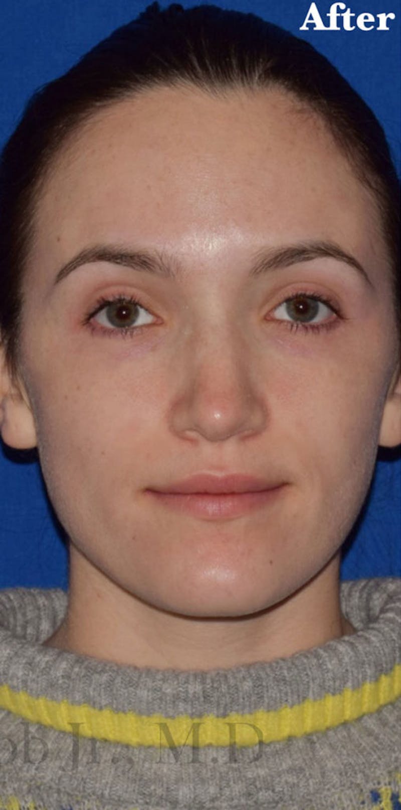 Nose Before & After Gallery - Patient 189961742 - Image 4
