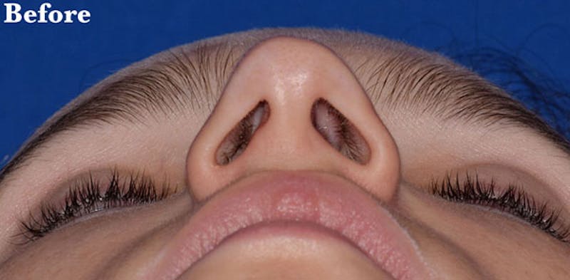 Nose Before & After Gallery - Patient 189961742 - Image 5