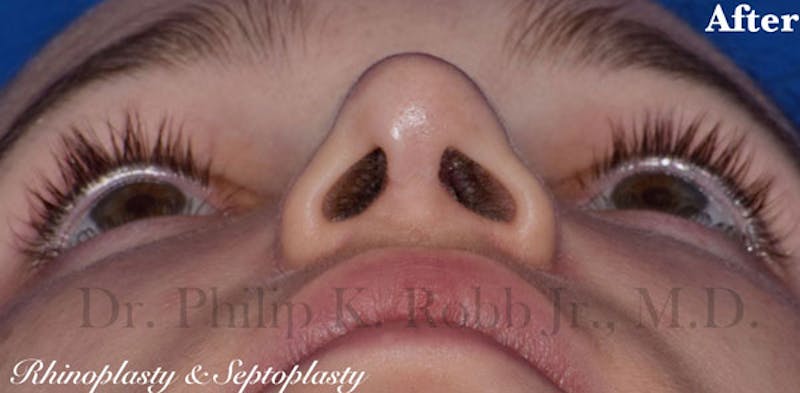 Nose Before & After Gallery - Patient 189961742 - Image 6