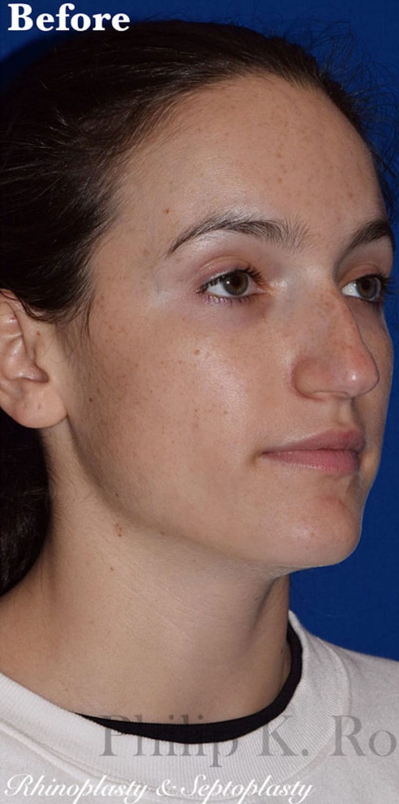 Nose Before & After Gallery - Patient 189961742 - Image 7