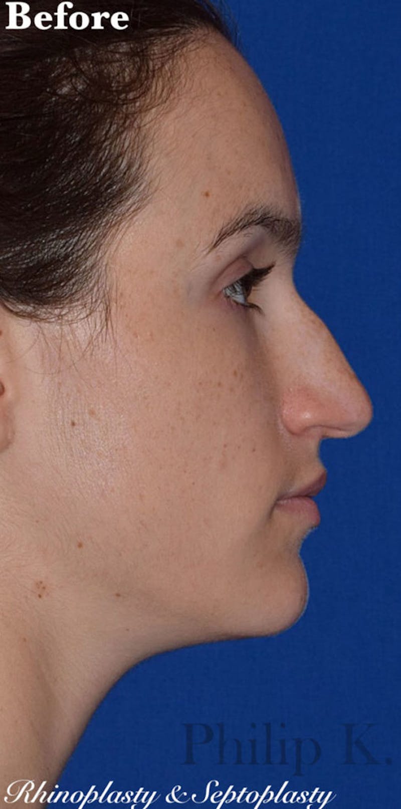 Nose Before & After Gallery - Patient 189961742 - Image 1