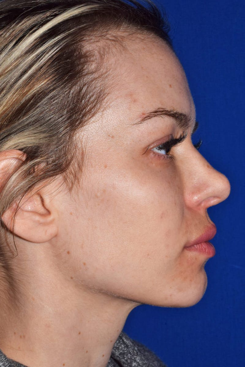 Nose Before & After Gallery - Patient 189963959 - Image 1
