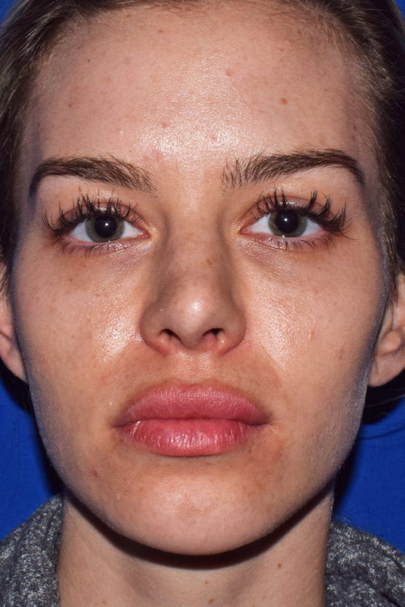 Nose Before & After Gallery - Patient 189963959 - Image 5