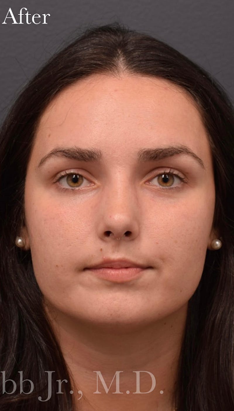 Nose Before & After Gallery - Patient 189964032 - Image 4