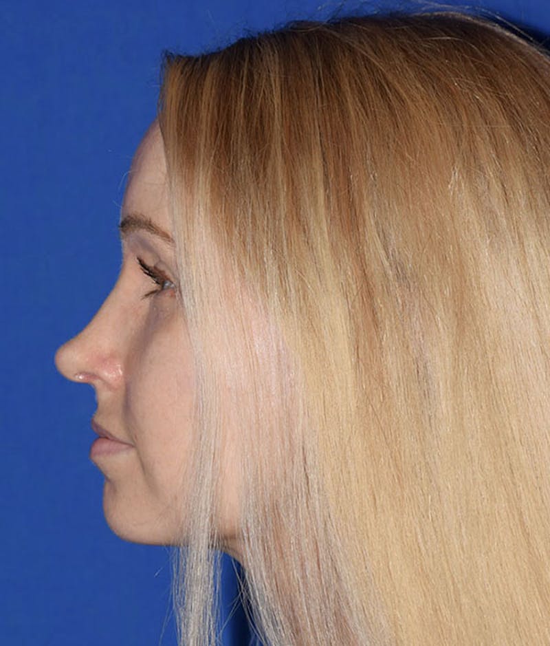 Nose Before & After Gallery - Patient 189964033 - Image 2