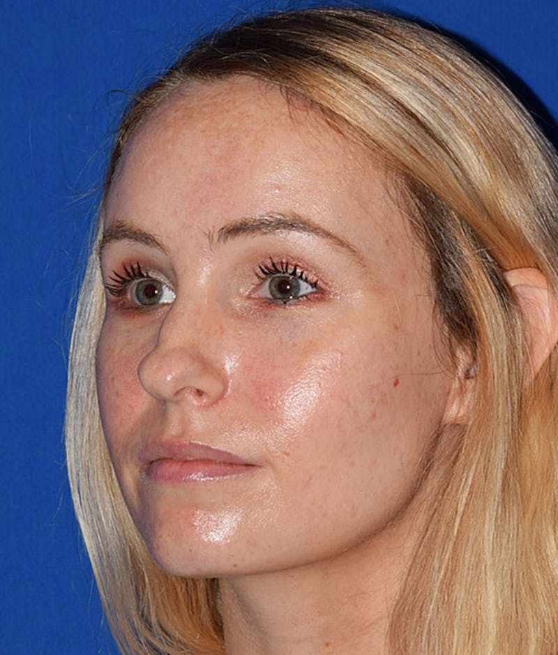 Nose Before & After Gallery - Patient 189964033 - Image 3