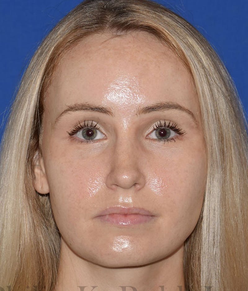 Nose Before & After Gallery - Patient 189964033 - Image 6