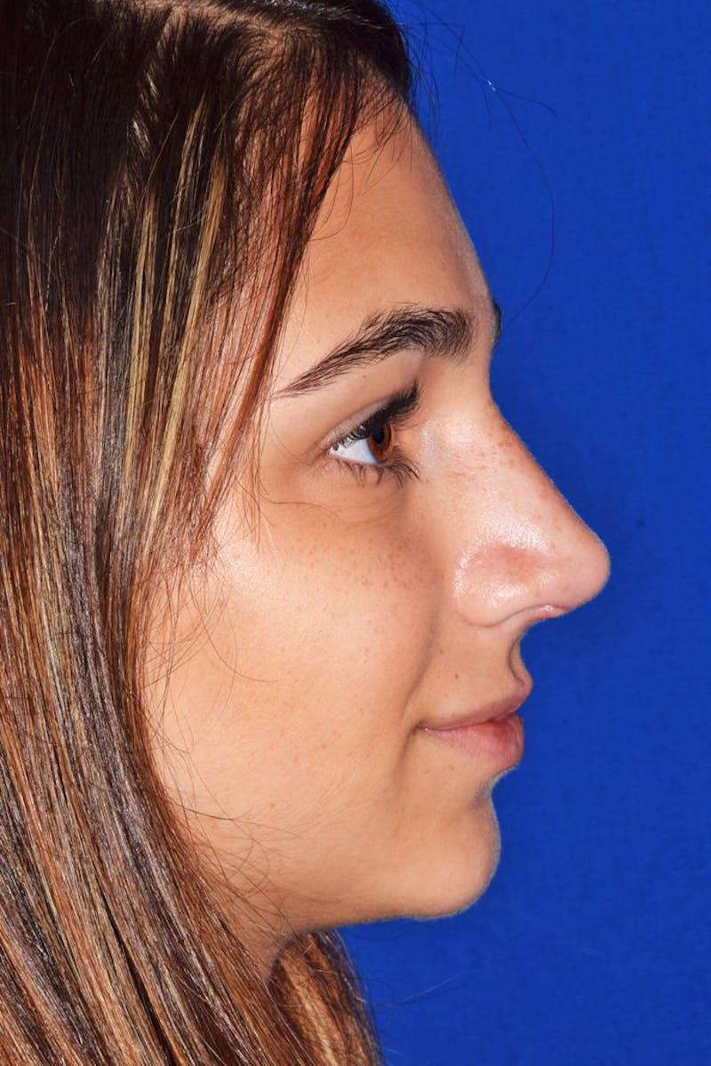 Nose Before & After Gallery - Patient 189964063 - Image 2