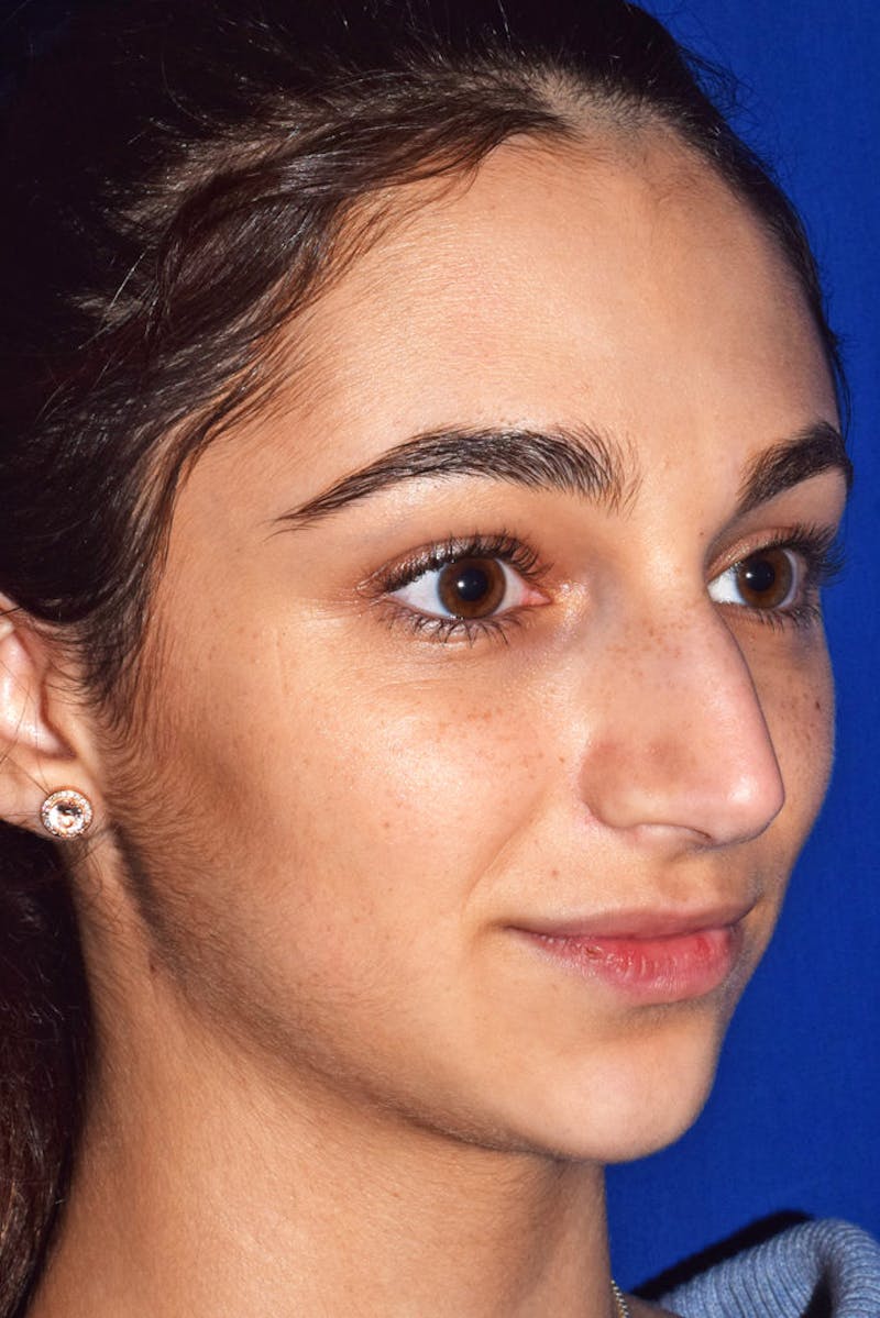 Nose Before & After Gallery - Patient 189964063 - Image 3