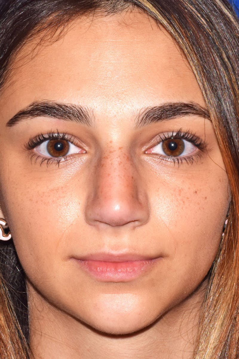 Nose Before & After Gallery - Patient 189964063 - Image 6