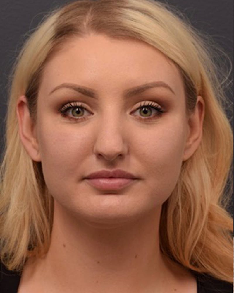Nose Before & After Gallery - Patient 189964106 - Image 3