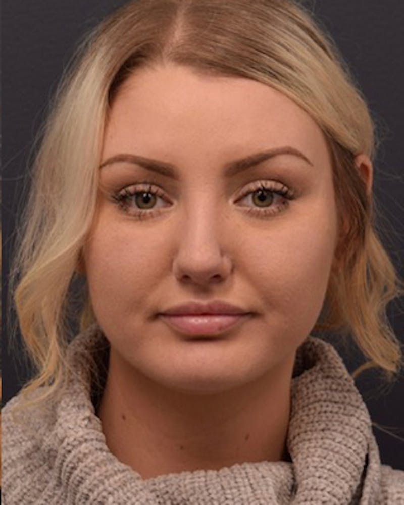 Nose Before & After Gallery - Patient 189964106 - Image 4