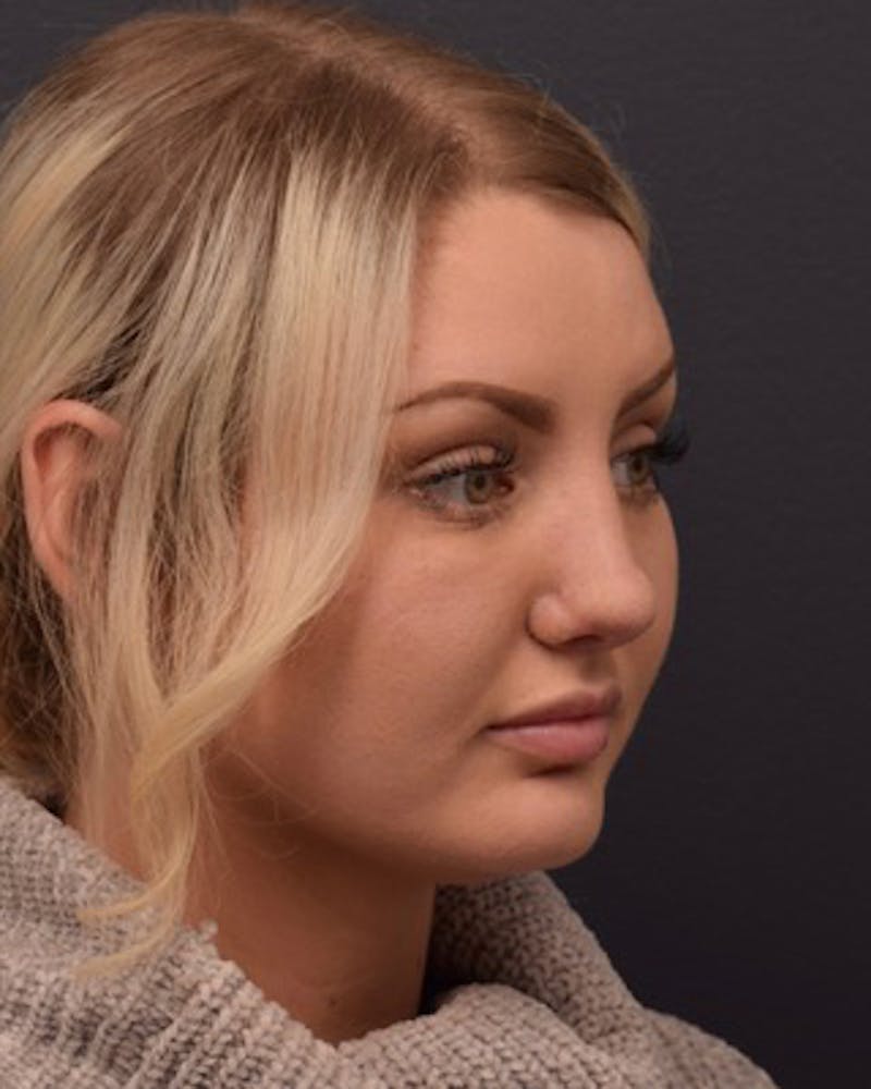 Nose Before & After Gallery - Patient 189964106 - Image 6
