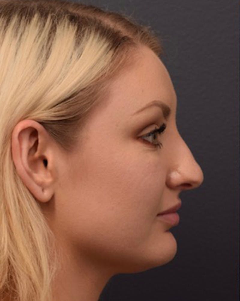 Nose Before & After Gallery - Patient 189964106 - Image 1