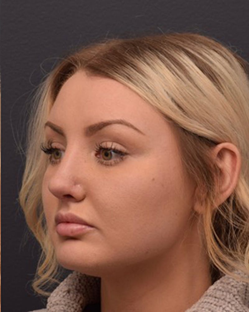 Nose Before & After Gallery - Patient 189964106 - Image 8