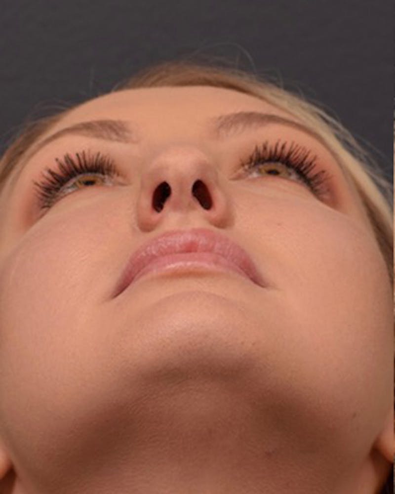 Nose Before & After Gallery - Patient 189964106 - Image 11