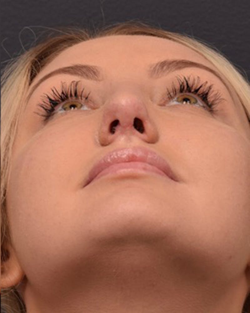 Nose Before & After Gallery - Patient 189964106 - Image 12