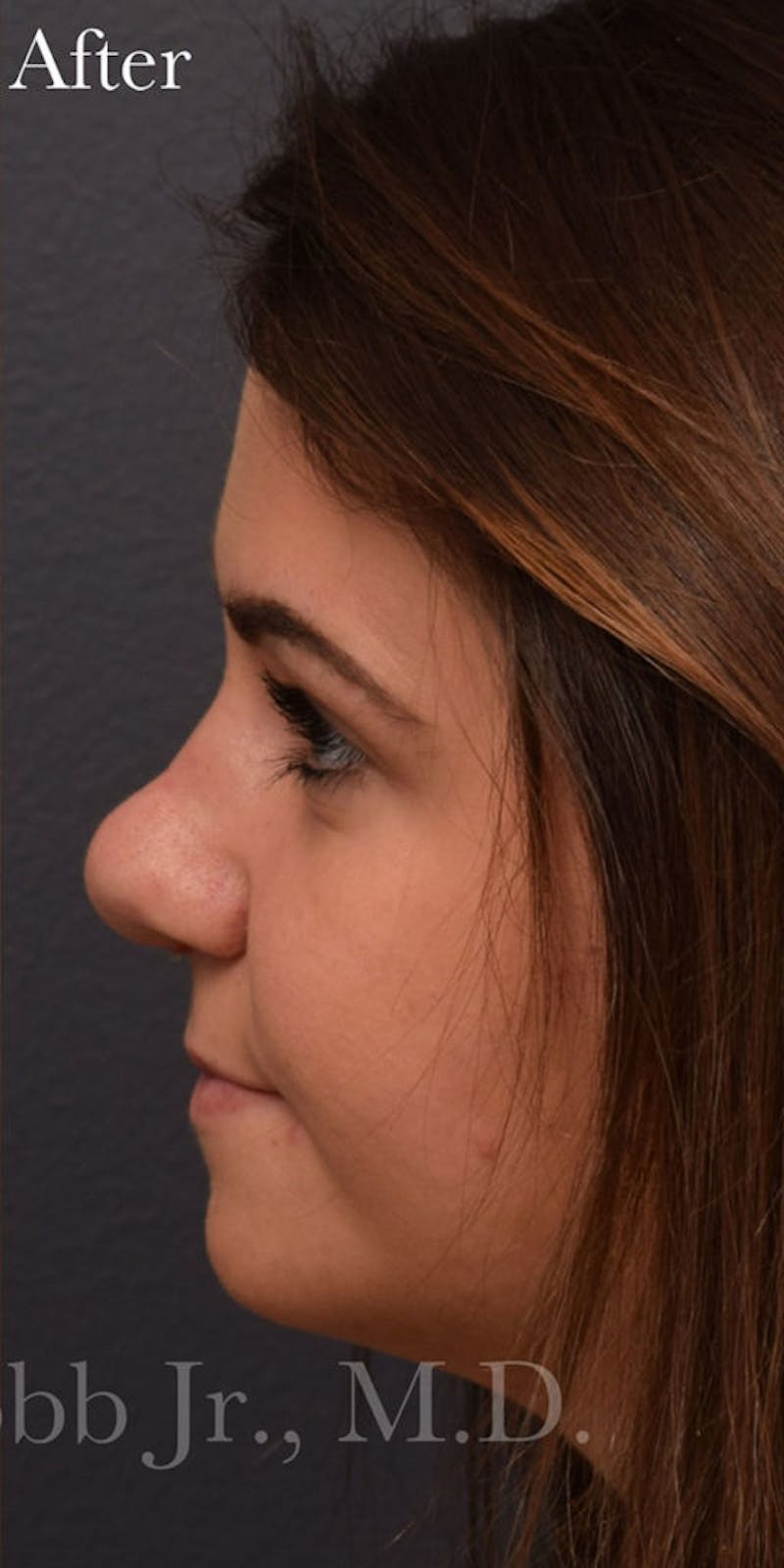 Nose Before & After Gallery - Patient 189964107 - Image 2