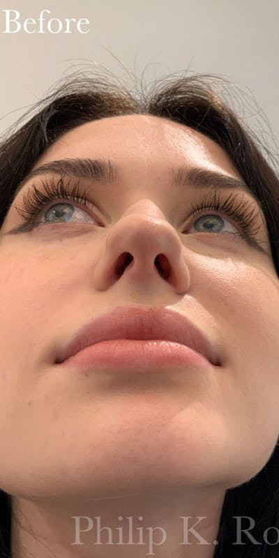 Nose Before & After Gallery - Patient 189964131 - Image 1