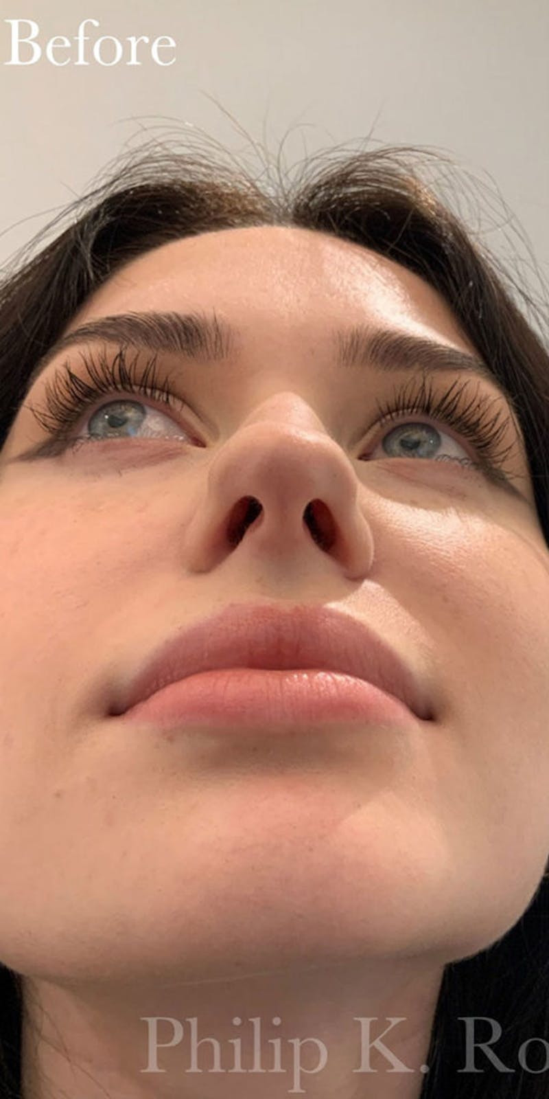 Nose Before & After Gallery - Patient 189964131 - Image 1
