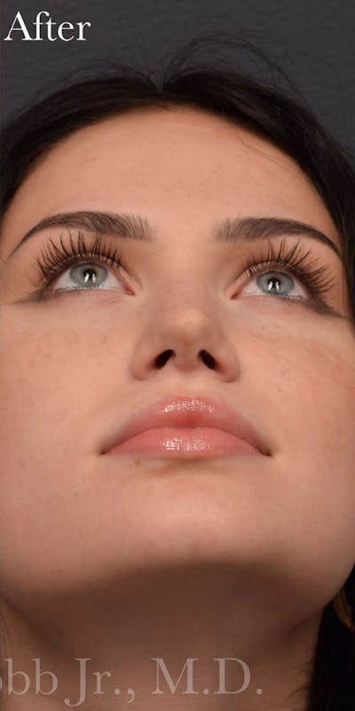 Nose Before & After Gallery - Patient 189964131 - Image 2