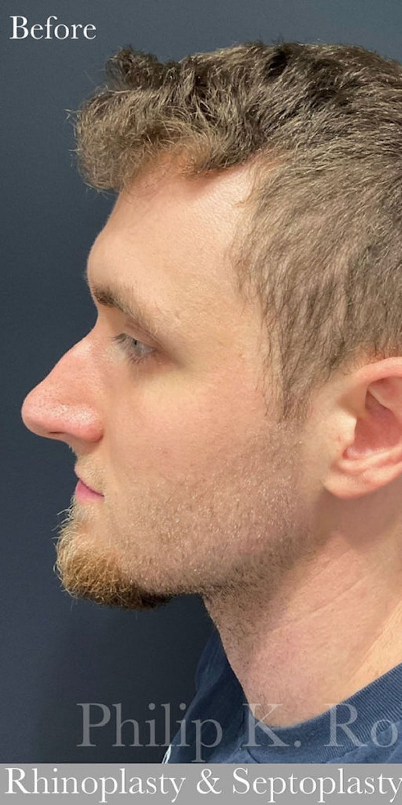Nose Before & After Gallery - Patient 189964141 - Image 1