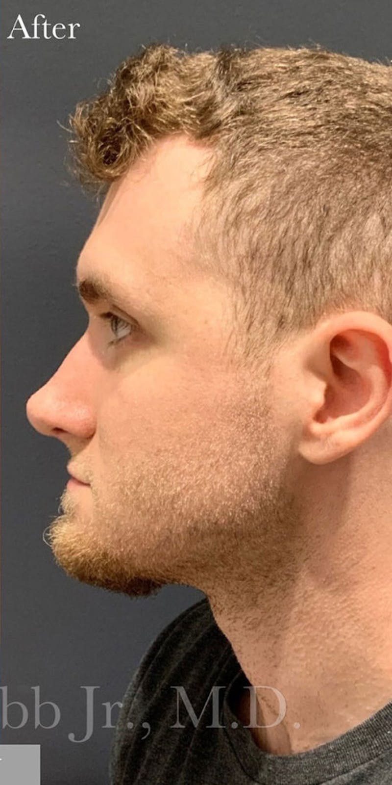 Nose Before & After Gallery - Patient 189964141 - Image 2