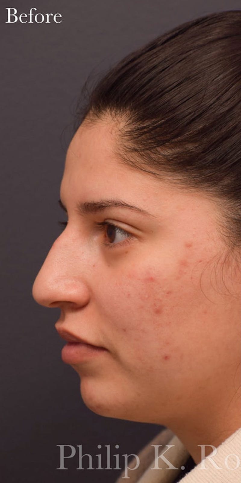 Nose Before & After Gallery - Patient 189964177 - Image 3