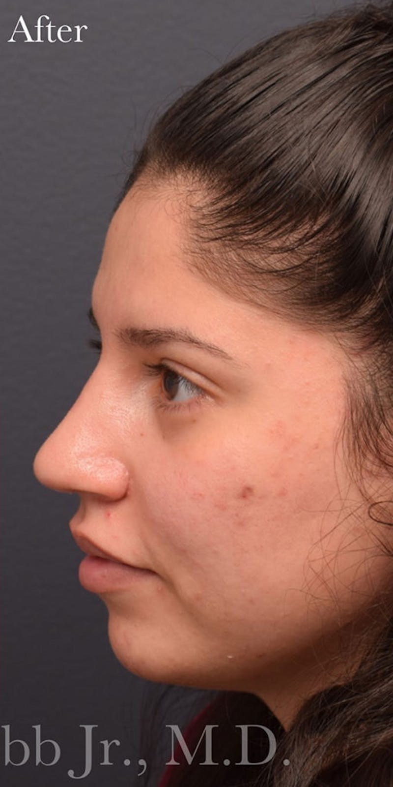 Nose Before & After Gallery - Patient 189964177 - Image 4