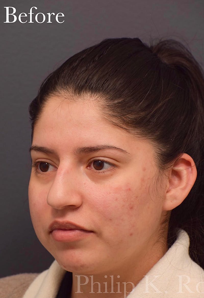 Nose Before & After Gallery - Patient 189964177 - Image 5
