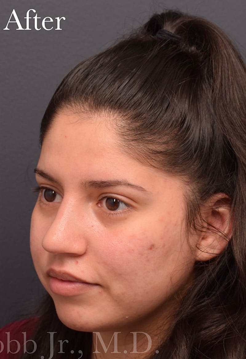 Nose Before & After Gallery - Patient 189964177 - Image 6