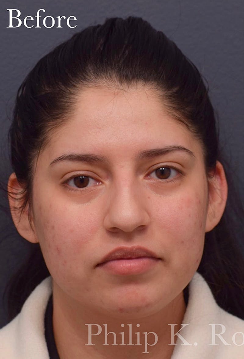 Nose Before & After Gallery - Patient 189964177 - Image 7