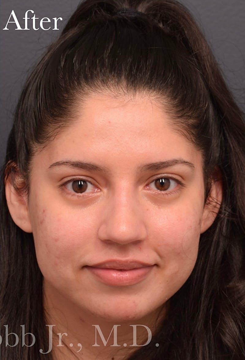 Nose Before & After Gallery - Patient 189964177 - Image 8