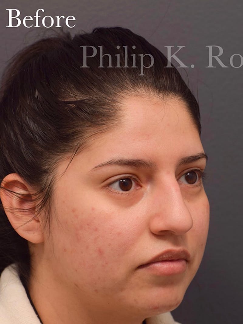 Nose Before & After Gallery - Patient 189964177 - Image 9