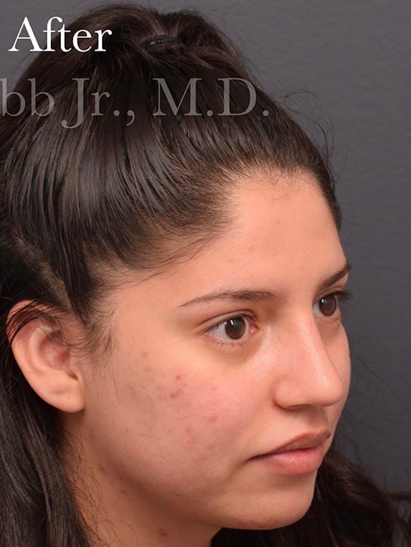 Nose Before & After Gallery - Patient 189964177 - Image 10