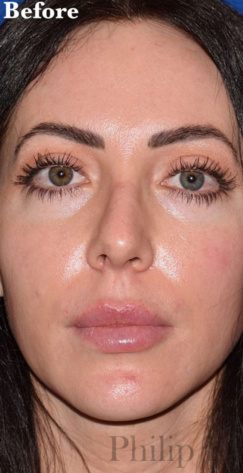 Nose Before & After Gallery - Patient 189964281 - Image 3