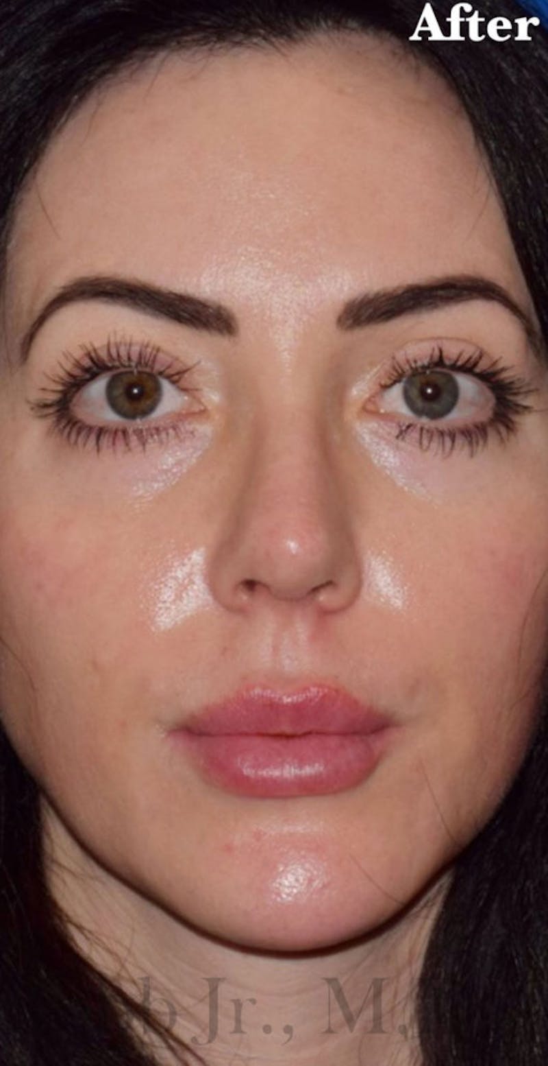 Nose Before & After Gallery - Patient 189964281 - Image 4