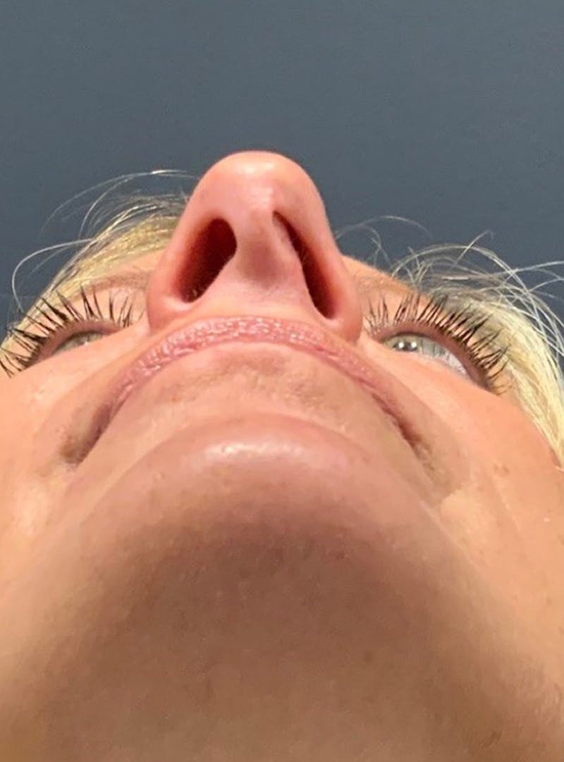 Nose Before & After Gallery - Patient 189964353 - Image 3