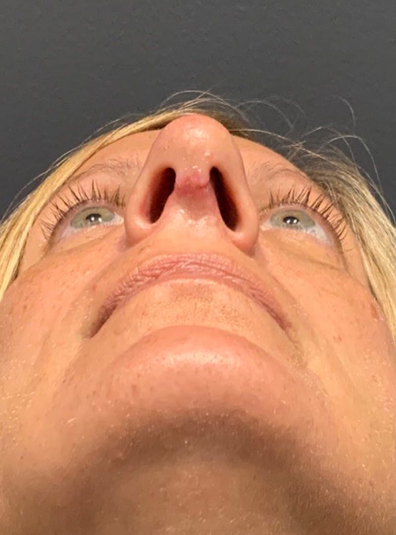 Nose Before & After Gallery - Patient 189964353 - Image 4